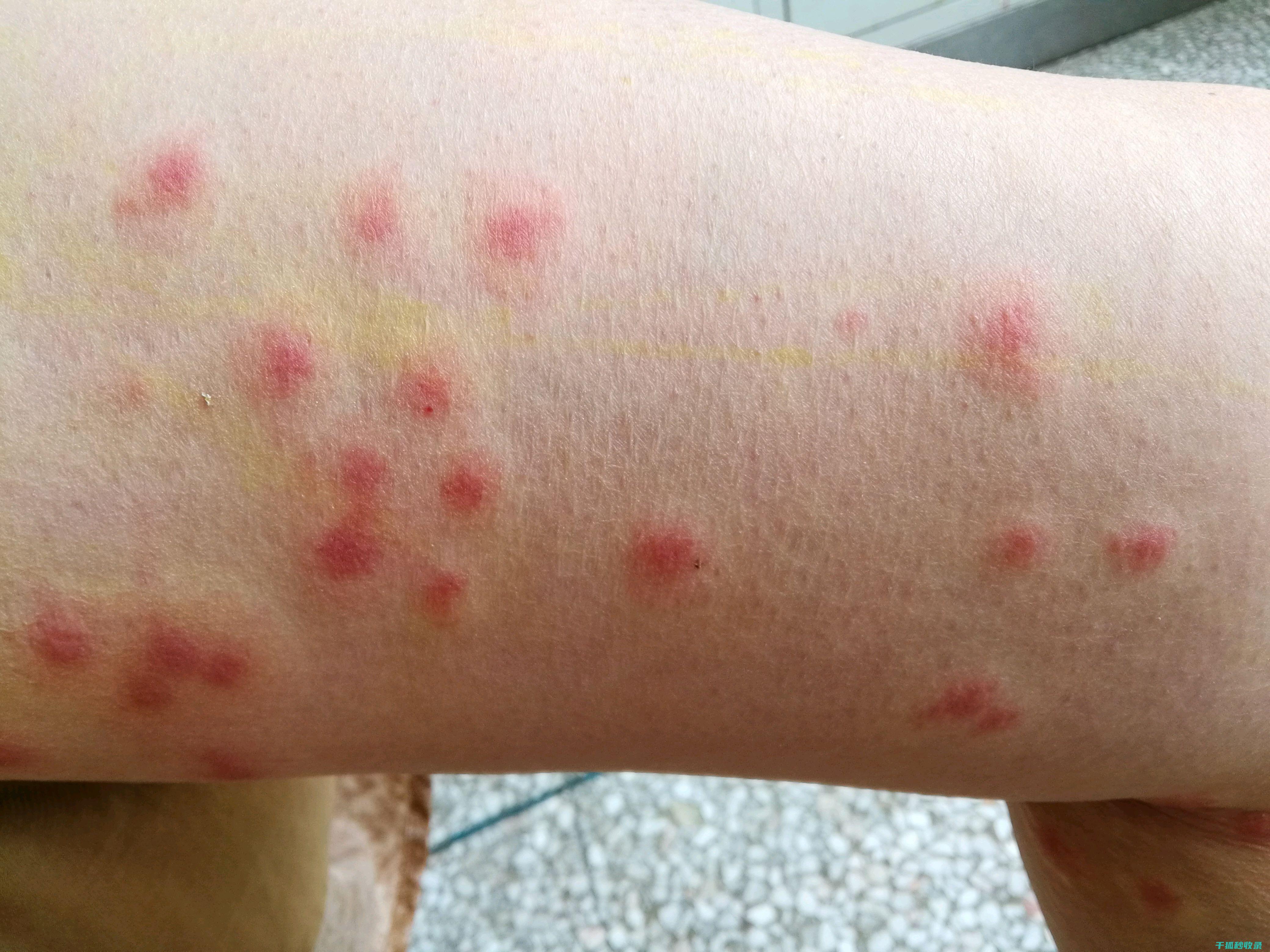 蚊虫叮咬后的止痒方法，这些你一定用得上 (蚊虫叮咬后的图片)